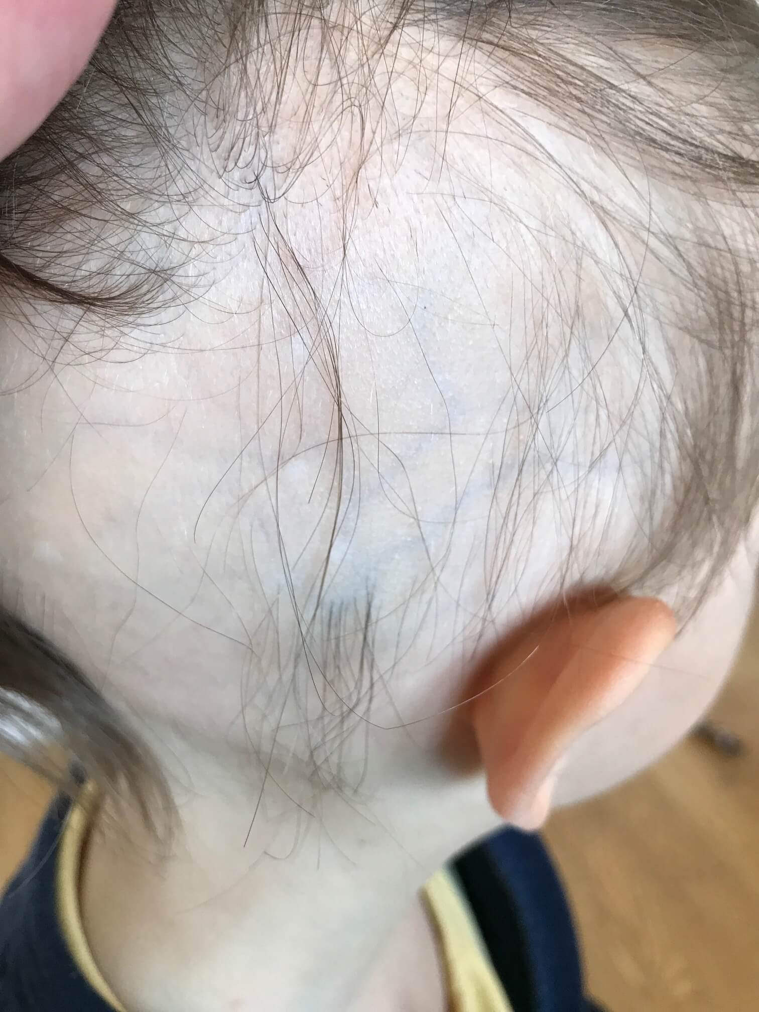 Les anomalies des cheveux et du cuir chevelu de l'enfant ...