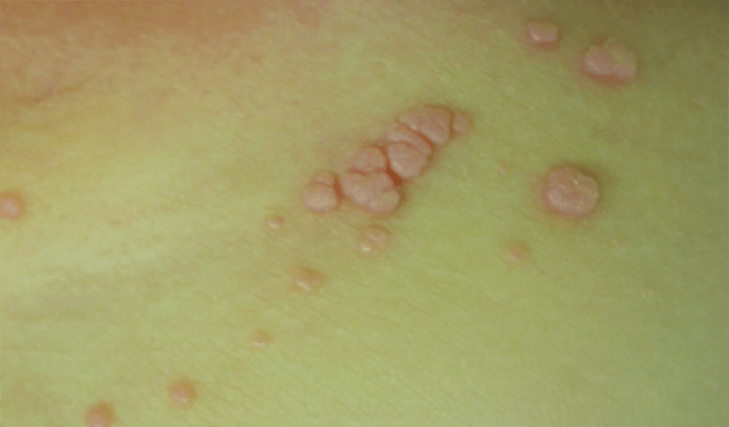 Pathologie vulvaire pédiatrique | Dermatologie Pratique