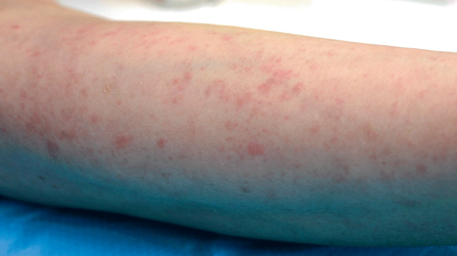 Allergie à l'eau et au froid | Dermatologie Pratique