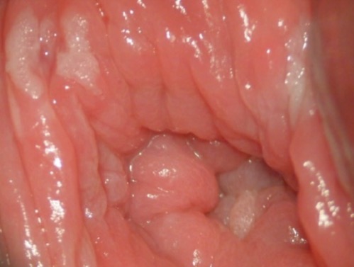 simptome ale verucilor genitale la nivelul intestinelor