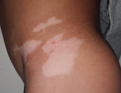 Vitiligo de l'enfant : que doit-on explorer ? | Dermatologie Pratique