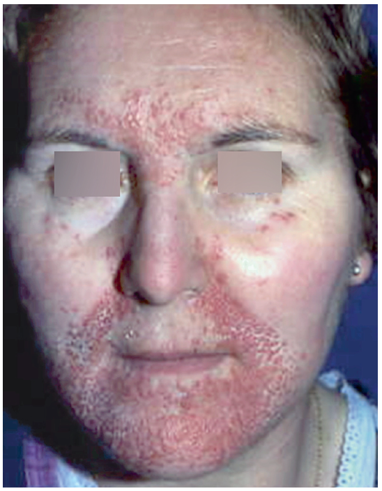 Rougeurs du visage Dermatologie Pratique