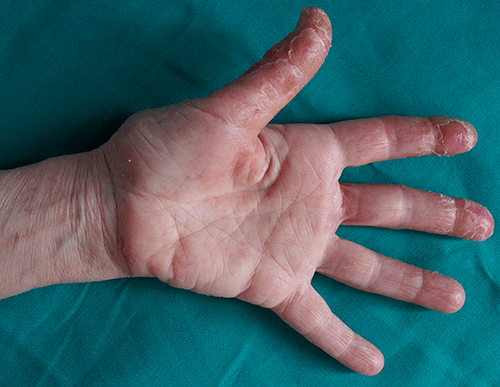 Dermatites des mains, les pièges à éviter | Dermatologie Pratique