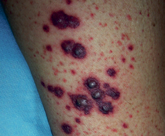 Vascularite cutanée - Classification, diagnostic | Homeopathic | Best Homeopathic Doctor in Pakistan | Dr Qaisar Ahmed MD, DHMS