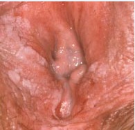 Périnée Bien-Aimé  La mycose vulvo-vaginale