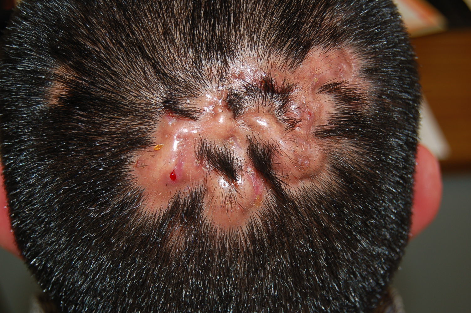 Que Faire Devant Une Folliculite Du Cuir Chevelu Dermatologie Pratique Que Faire Devant Une Folliculite Du Cuir Chevelu Dermatologie Pratique