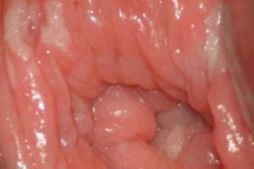 condylom vulvar