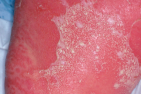 Psoriasis Severe Au Cœur De La Voie Il 23 Dermatologie Pratique Psoriasis Severe Au Cœur De La Voie Il 23 Dermatologie Pratique