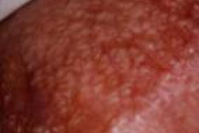 papillomavirus homme mst