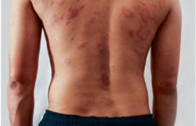 Baricitinib en association avec les dermocorticoïdes dans la dermatite atopique modérée à sévère