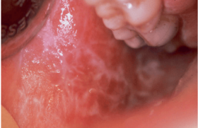 Le lichen plan buccal