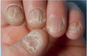 L’ongle, une mystérieuse boule de cristal ? –  De l’onychomancie à la dermatologie, peut-on vraiment lire sur les ongles ?