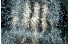 La pachydermie occipitale vorticellée du cuir chevelu (cutis verticis gyrata)