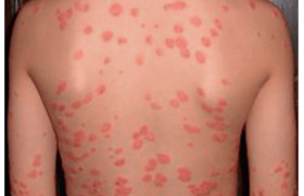 Psoriasis de l’enfant : prendre en compte les particularités liées à l’âge