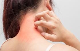 La dermatite atopique à l’heure des inhibiteurs de JAK