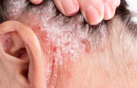 Psoriasis : première démonstration de l’efficacité d’un traitement d’entretien topique à long terme