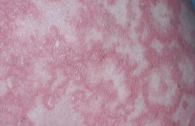 Quelle gestion en pratique du traitement du psoriasis pendant la grossesse ?