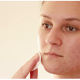 Comment traiter l’acné fulminans