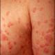 Psoriasis : le bimekizumab agit vite et longtemps