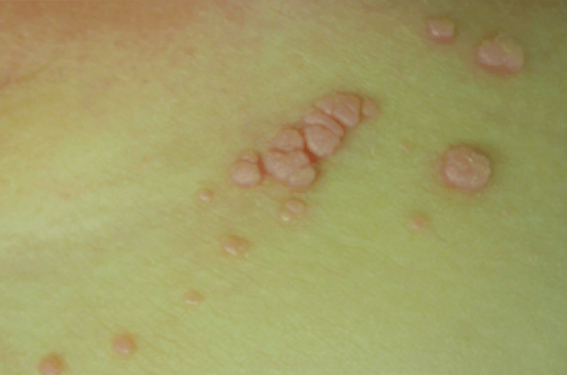 Pathologie vulvaire pédiatrique | Dermatologie Pratique