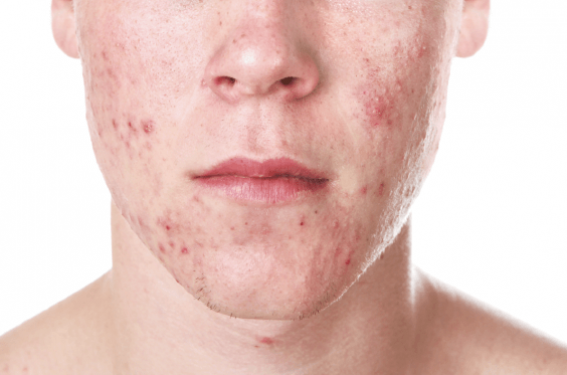 L’adolescent, l’acné, le pédiatre et le psychiatre | Dermatologie Pratique