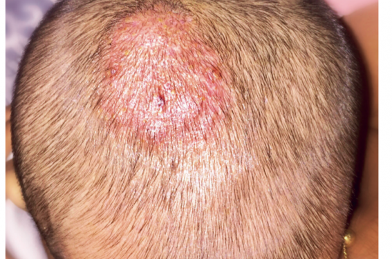 Actualité dans les dermatoses infectieuses pédiatriques