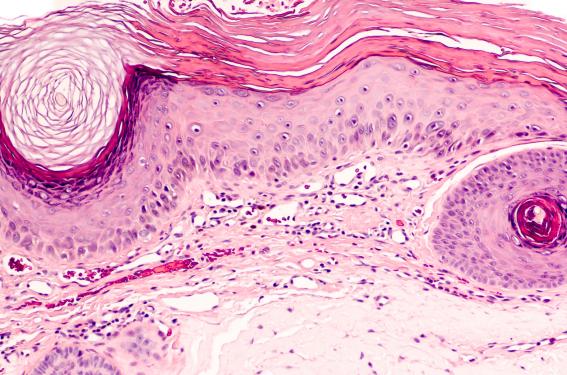 Risque d’événements indésirables cardiovasculaires et de cancer sous tofacitinib