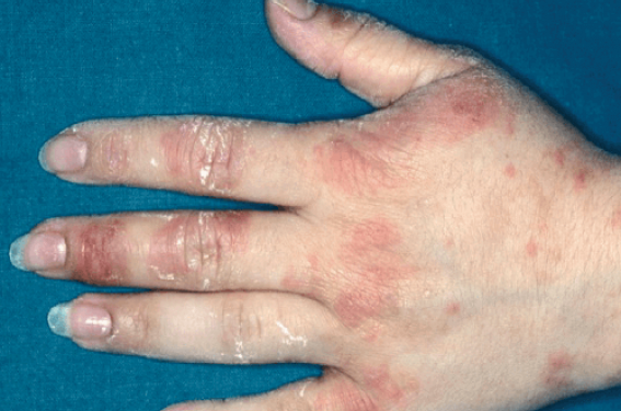 Allergies de contact « per- et postopératoires » | Dermatologie ...