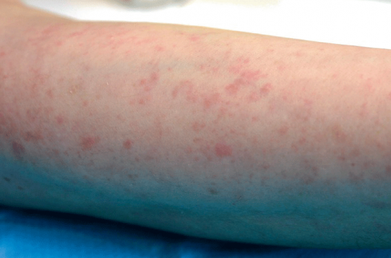Allergie à l'eau et au froid | Dermatologie Pratique