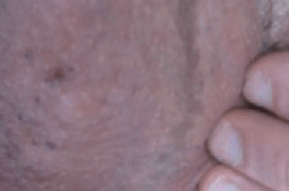 Les principales dermatoses du scrotum | Dermatologie Pratique