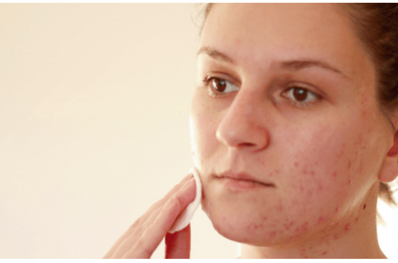 Comment traiter l’acné fulminans