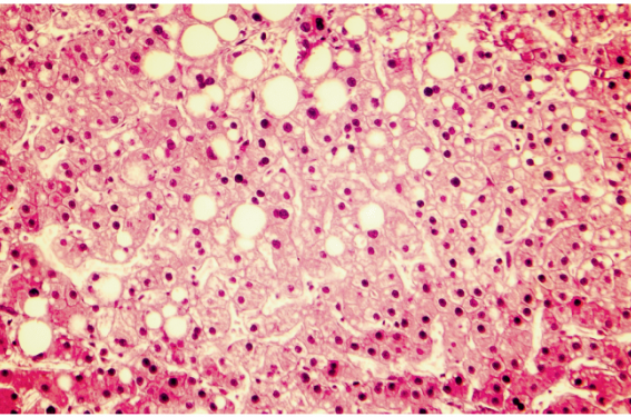 Le VEXAS : une nouvelle maladie auto-inflammatoire de l’adulte que doit connaître le dermatologue