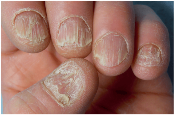 L’ongle, une mystérieuse boule de cristal ? –  De l’onychomancie à la dermatologie, peut-on vraiment lire sur les ongles ?