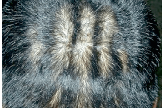 La pachydermie occipitale vorticellée du cuir chevelu (cutis verticis gyrata)