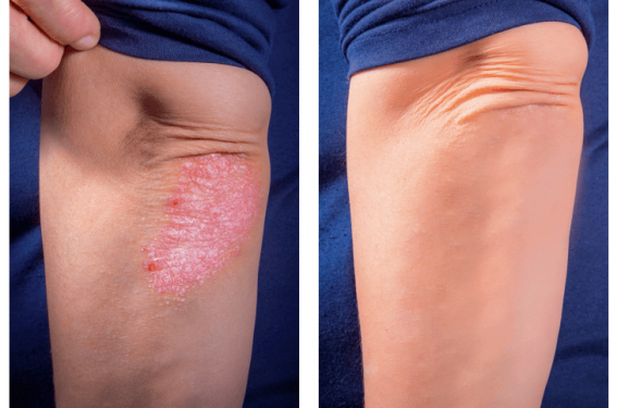 Contrôler le psoriasis : une réalité en 2020 ?