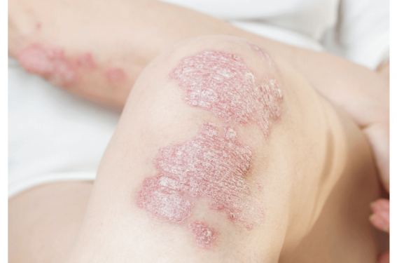 Psoriasis, vers la personnalisation de la prise en charge