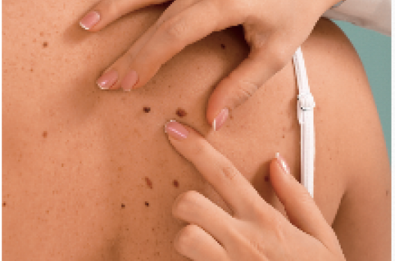 Chirurgie d’exérèse et ganglion sentinelle dans le mélanome primitif
