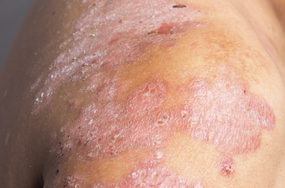 Quoi de neuf dans la dermatite atopique ?