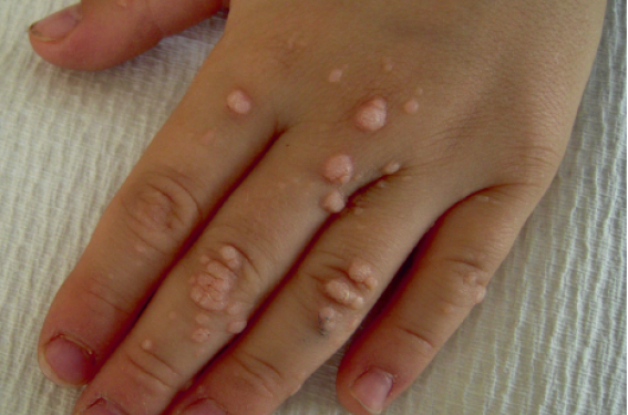 Traiter les verrues | Dermatologie Pratique