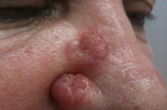 Existe-t-il un sur-risque de carcinome cutané sous anti-JAK ?