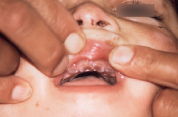 Formes inhabituelles de porphyrie érythropoïétique congénitale spontanément régressive : suivi de cas familiaux sur 28 ans
