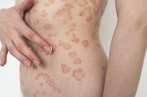 Psoriasis : comment gérer les situations difficiles
