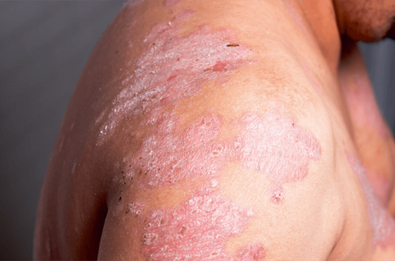 Dermatite atopique sévère Les critères pour choisir entre biothérapie ou inhibiteurs de JAK