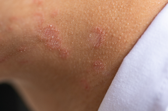 La dermatite atopique : au-delà de la peau et du topique
