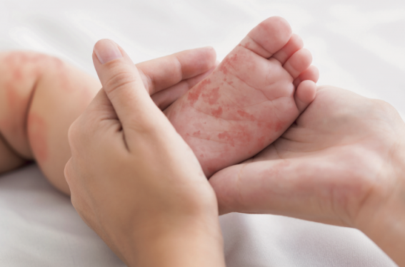 Dermatite atopique : quand faire un bilan allergologique ?