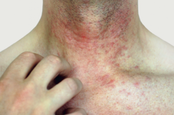 Tralokinumab : un anti-IL-13 dans la dermatite atopique