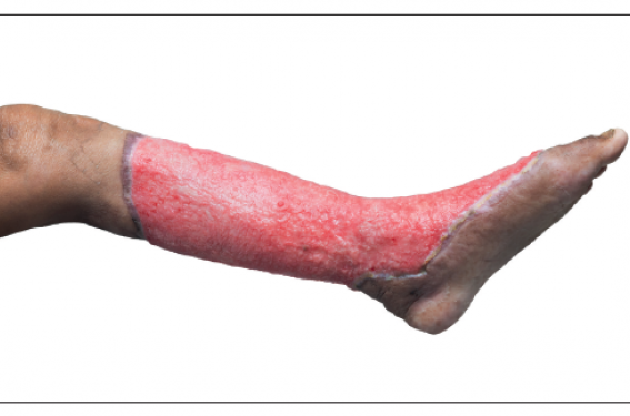 Dermatoses aiguës graves : du syndrome de Lyell à la fasciite nécrosante