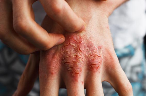 Eczéma allergique : allergènes connus, allergènes émergents