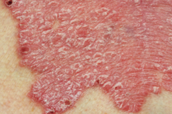 Éducation thérapeutique du patient dans le psoriasis