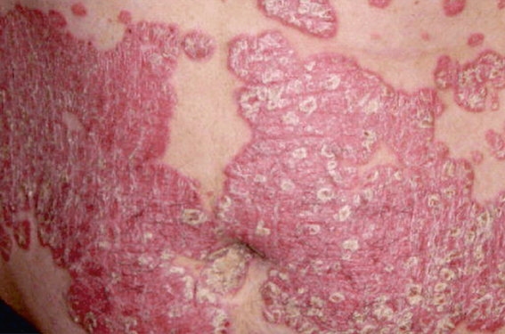Élargir le bilan psoriasique au-delà des lésions cutanées